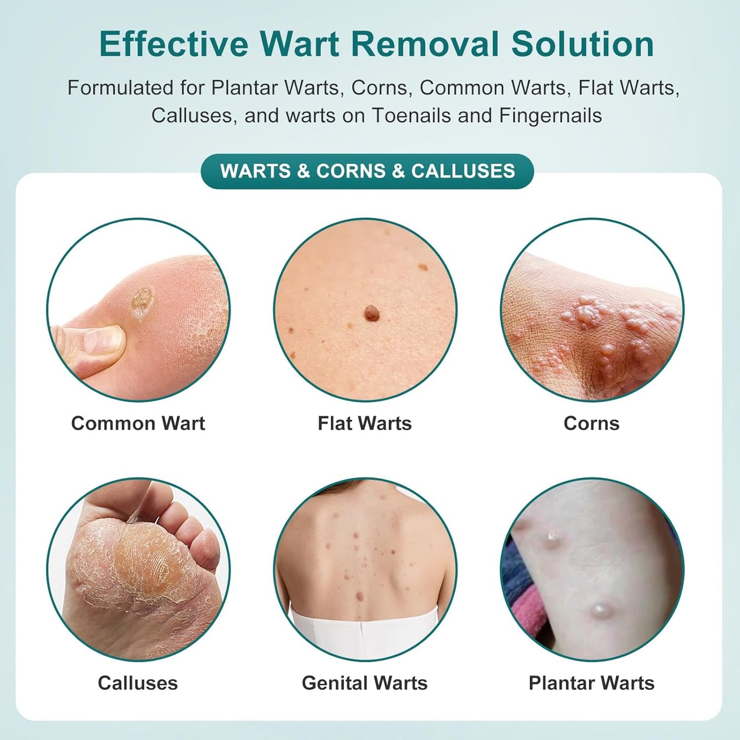 Tag Removal Wart Remover Fast Acting Gel – Maximum Strength Freeze Off Ointmen Fast Acting Natural Common Wart Removal for Plantar,Genital,H (Green-b, S)